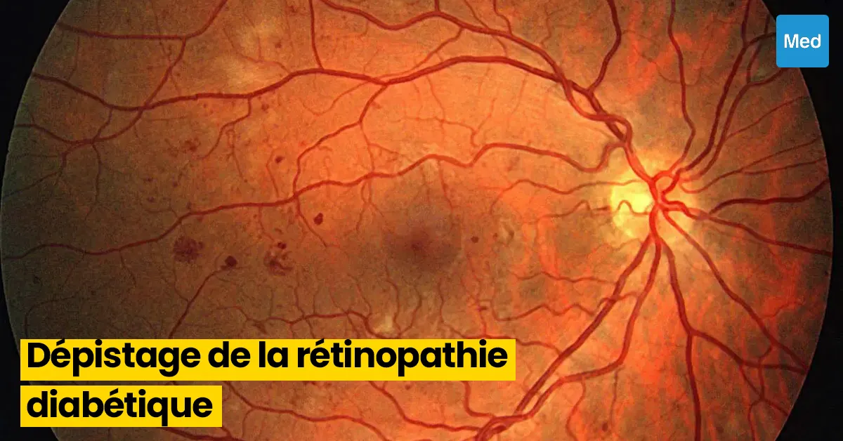 L'Importance du Dépistage Précoce de la Rétinopathie Diabétique